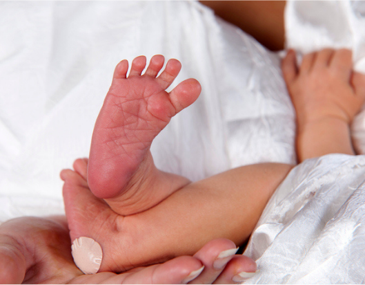 Newborn babies feet with heel prick marks to test for Fragile X