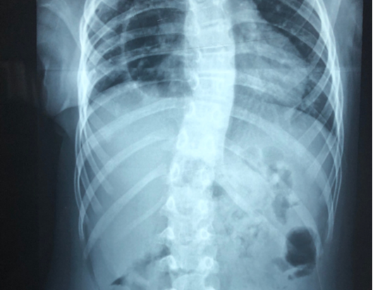 X-ray of child's spine