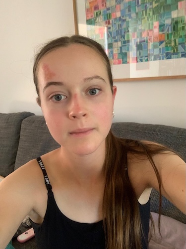 Macy after suffering a concussion from a surfboarding accident