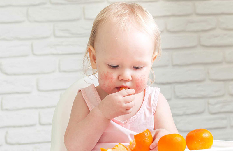 Baby eating oranges with allergic reation