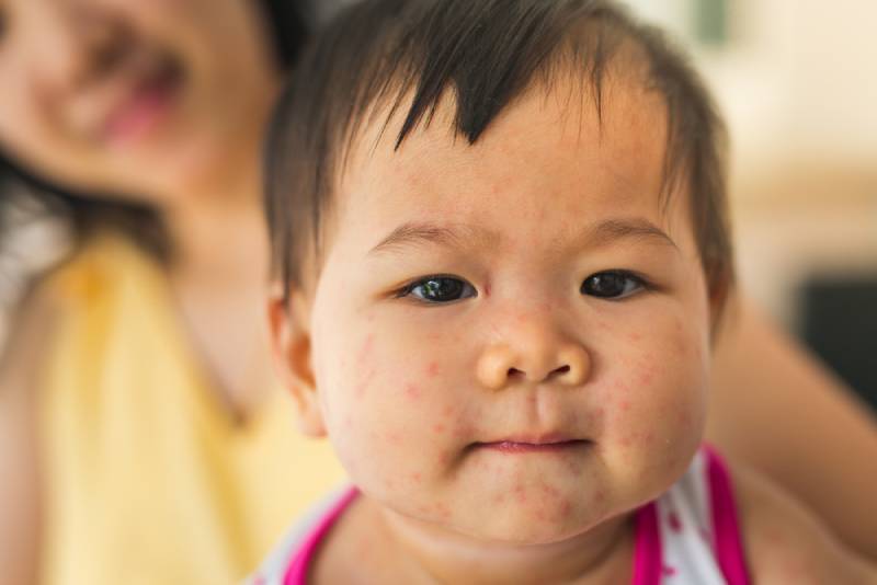 child with measles