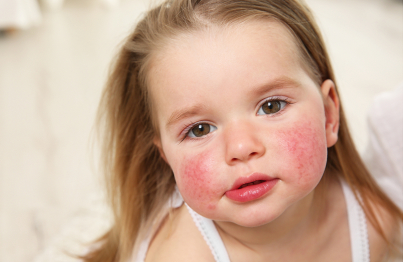 Child with allergy